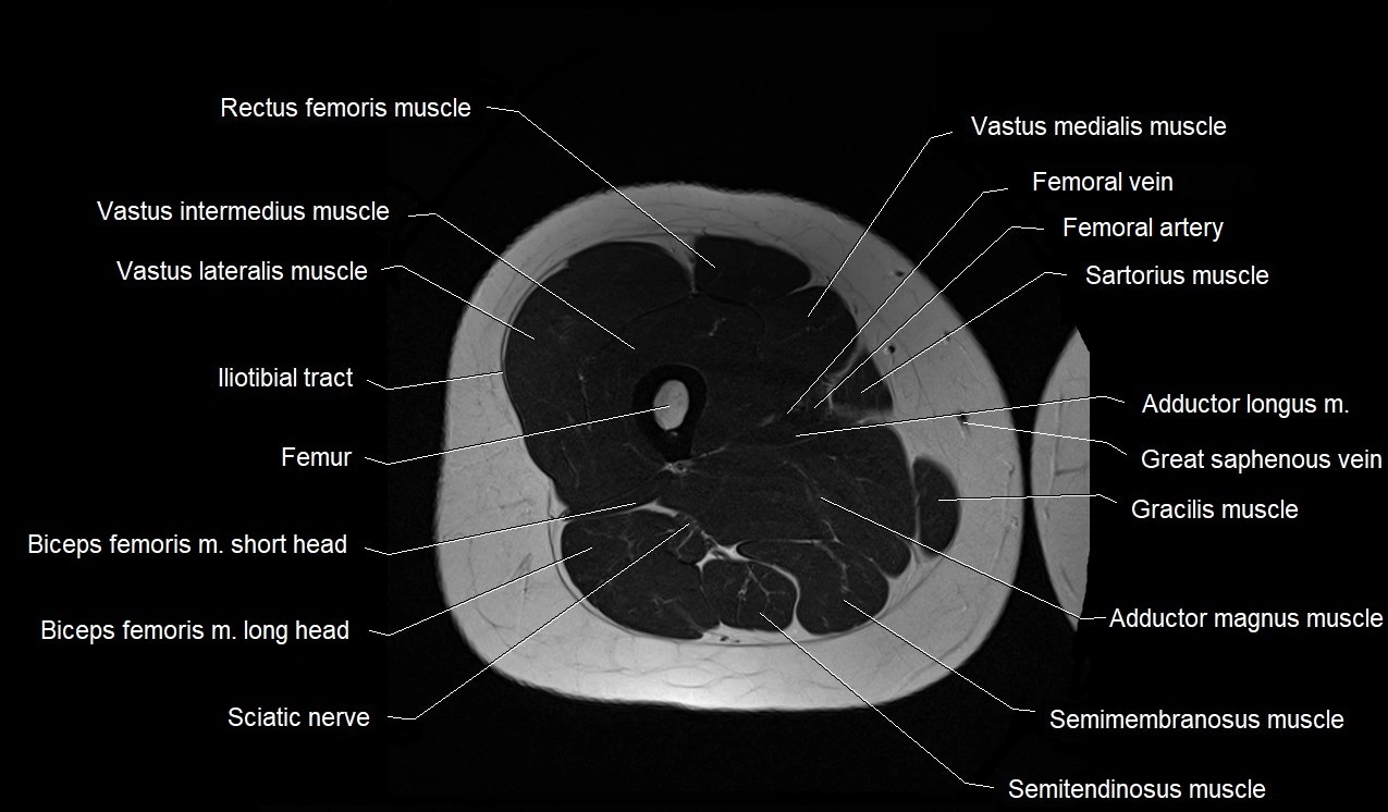 MRI thigh cross sectional anatomy image 32.webp